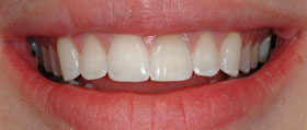 Vancouver Island Teeth Whitening