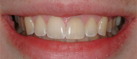 Vancouver Island Teeth Whitening