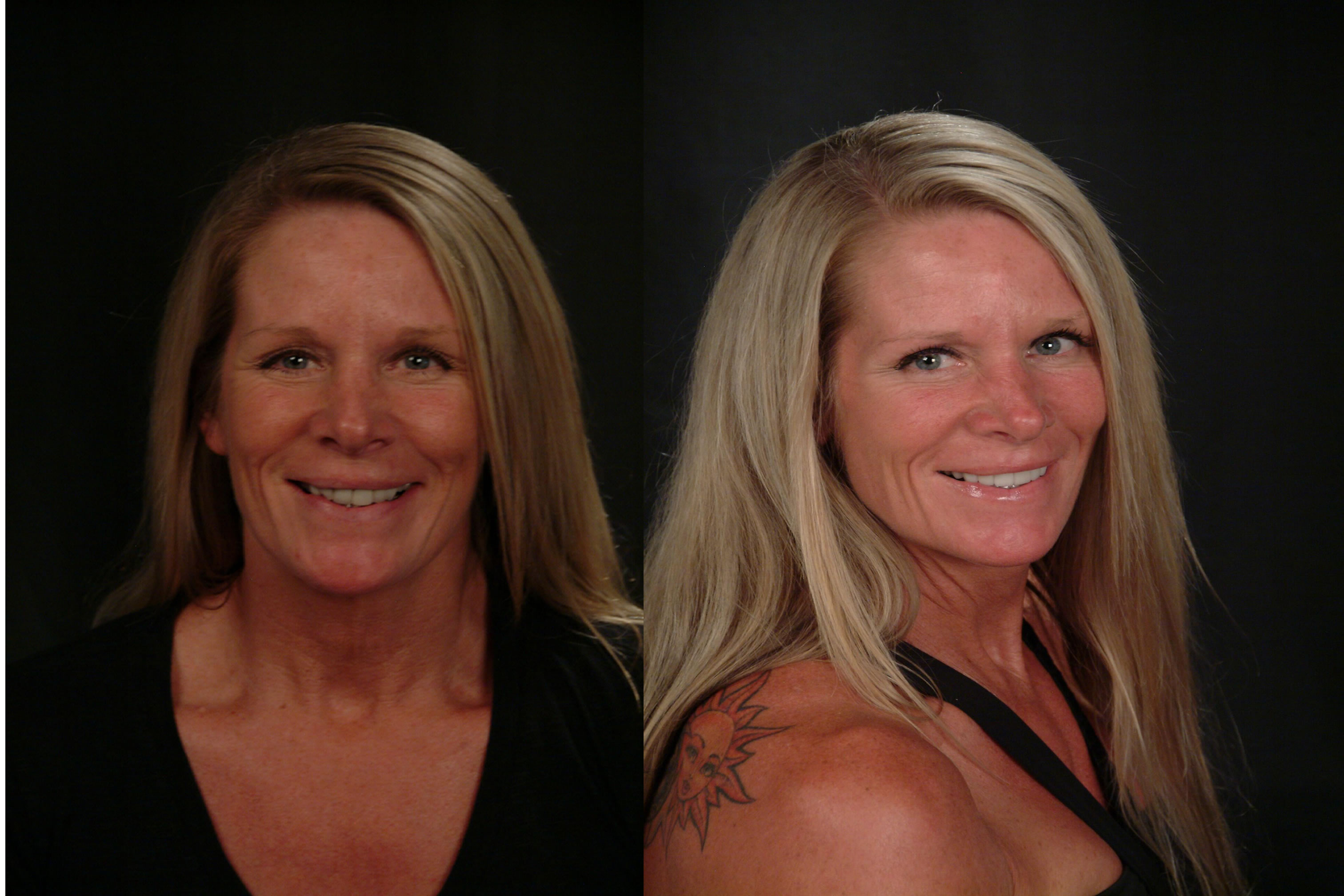 Vancouver Island Smile Makeover