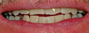 Vancouver Island Full Mouth Reconstruction Vancouver Island Full Mouth Reconstruction