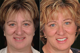 Vancouver Island Smile Makeover
