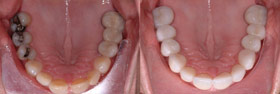 Vancouver Island Smile Makeover