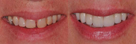Vancouver Island Smile Makeover
