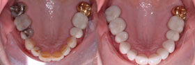 Vancouver Island Smile Makeover