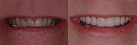 Vancouver Island Smile Makeover