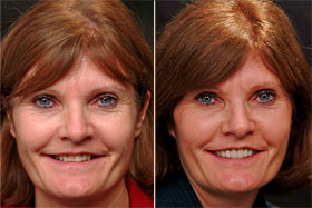 Vancouver Island Smile Makeover