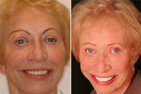 Vancouver Island Smile Makeover