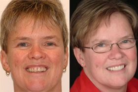 Vancouver Island Smile Makeover