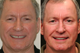 Vancouver Island Smile Makeover