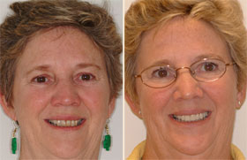 Vancouver Island Smile Makeover